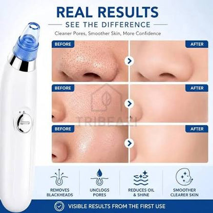 DermaPure Pro 5-Level Electric Pore Vacuum Blackhead Remover
